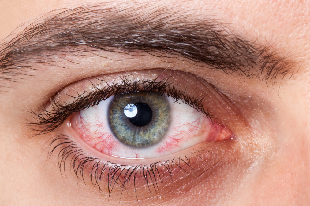 Do Edibles Make Your Eyes Red? What to Know Evn
